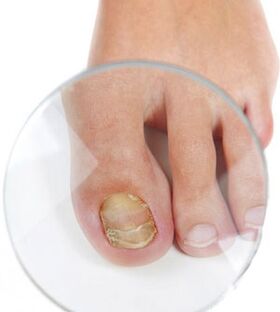 Nagelpilz