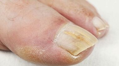 Die erste Phase der Nagelpilzentwicklung