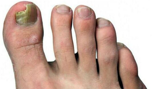 Nagelquetschen