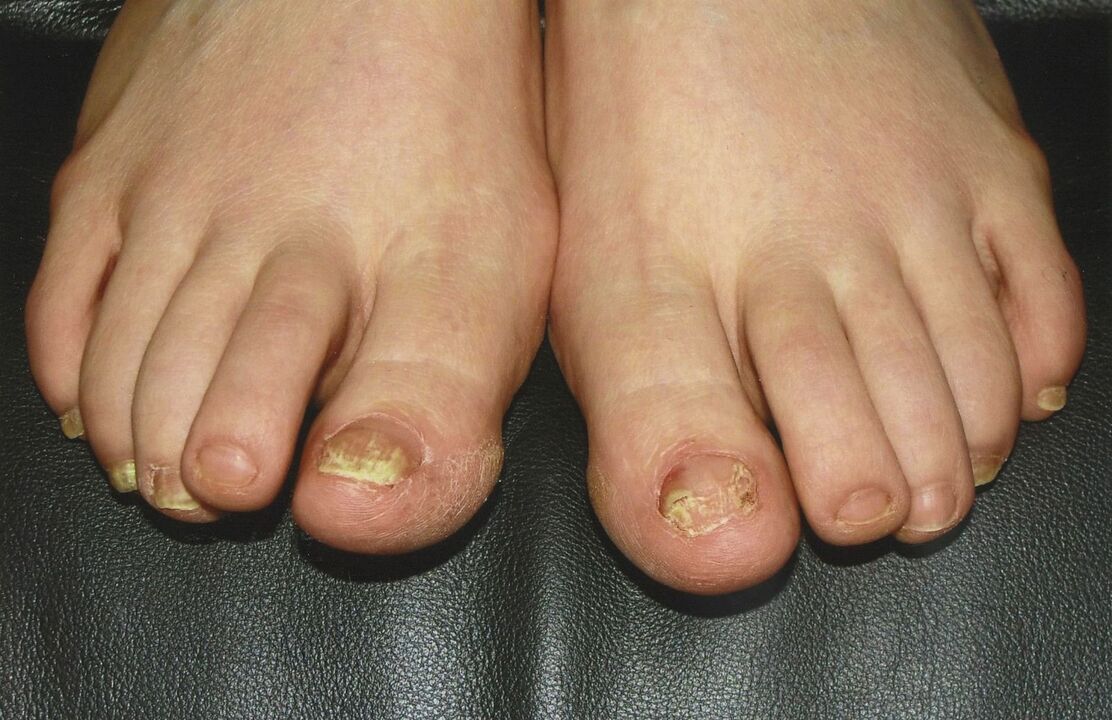 So behandeln Sie Zehennagelpilz mit Nagellack.