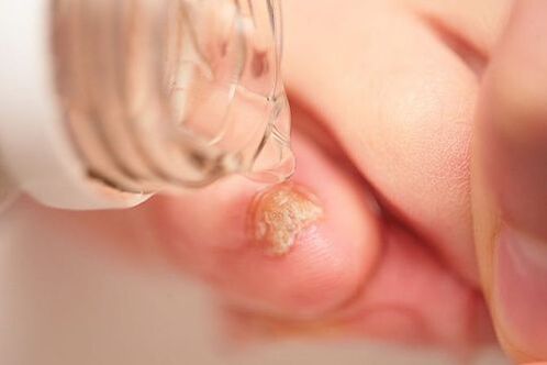 Apfelessig gegen Nagelpilz.