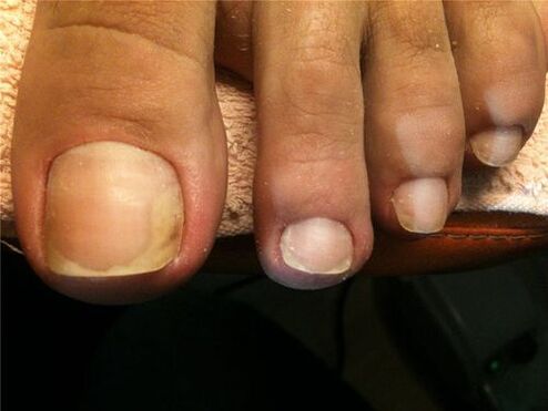 Pilzinfektion der Nagelplatte