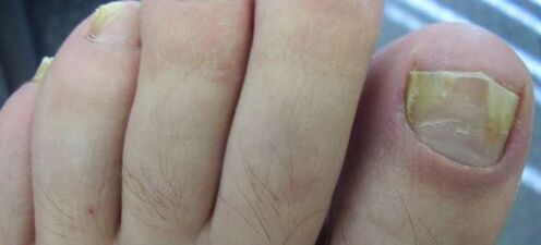 Symptome von Nagelpilz und seine Behandlung mit Essig