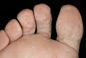 Die Haut der Füße mit einer Pilzinfektion. 