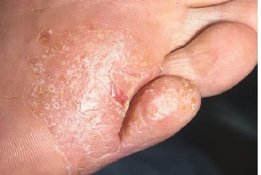 Manifestationen einer Pilzinfektion der Fußhaut. 