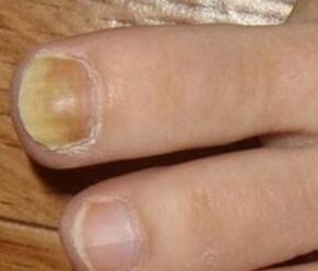 Symptome des Anfangsstadiums von Nagelpilz
